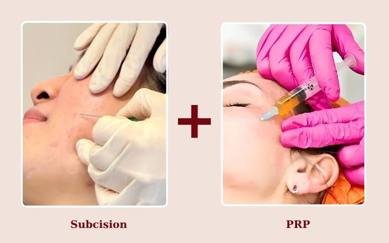 PRP kết hợp Subcision tăng cường tái sinh collagen