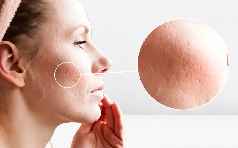 Tìm hiểu dấu hiệu, nguyên nhân và cách trị sẹo đáy vuông