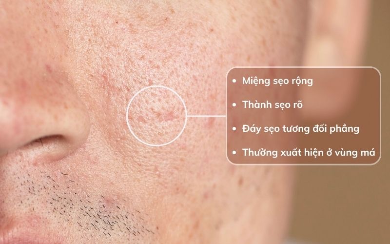 Dấu hiệu nhận biết sẹo đáy vuông qua hình dạng, thành sẹo và phần đáy