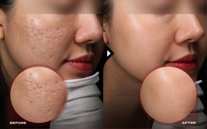 Sẹo lõm có tự đầy không?
