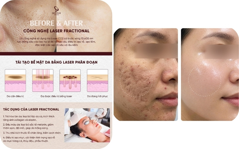 Trị sẹo lõm bằng Laser CO2 Fractional mang lại hiệu quả rõ rệt