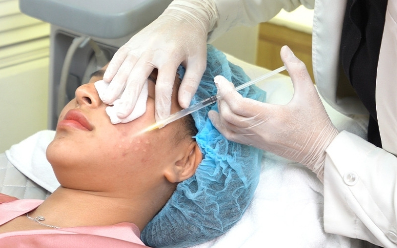 Trị sẹo rỗ bằng cách tiêm Filler làm đầy sẹo lõm