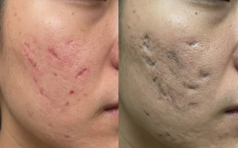Sẹo lõm lâu năm khác sẹo mới hình thành chủ yếu ở độ xơ hóa của chân sẹo