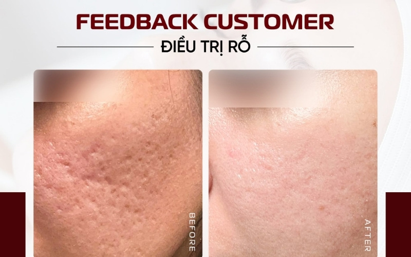 Laser Fractional CO2 kích thích quá trình tái tạo và tăng sinh collagen, elastin