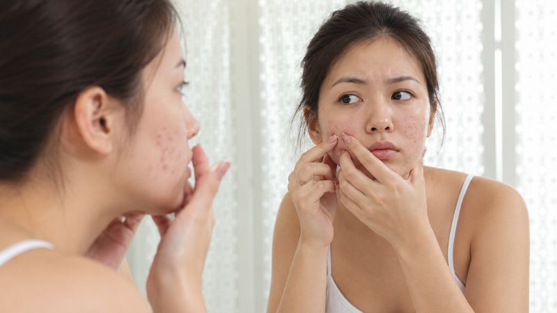 Bóp hoặc cạy mụn không đúng cách dễ gây tổn thương và viêm da