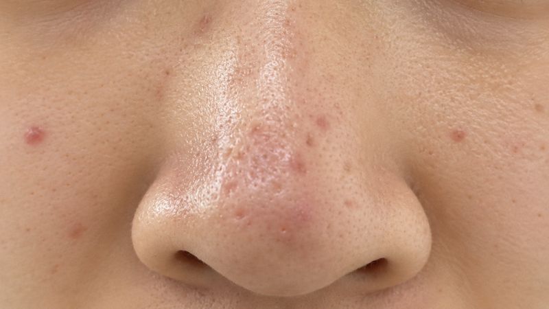 Sẹo rỗ ở mũi là các vết lõm không đều, gây mất thẩm mỹ