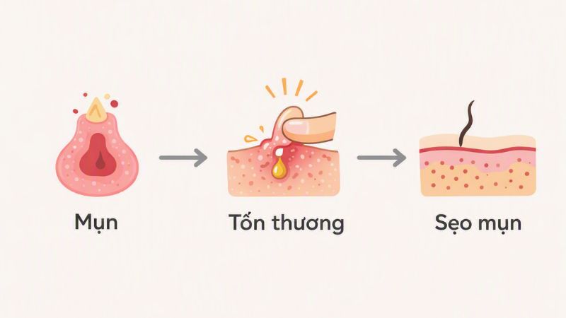 Nặn mụn sai cách có thể gây tổn thương da và hình thành sẹo rỗ