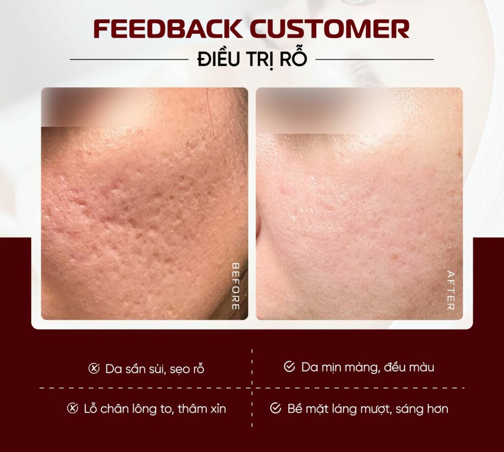 Kết quả trước và sau Meso Scar Therapy tại Shynh Medical Clinic
