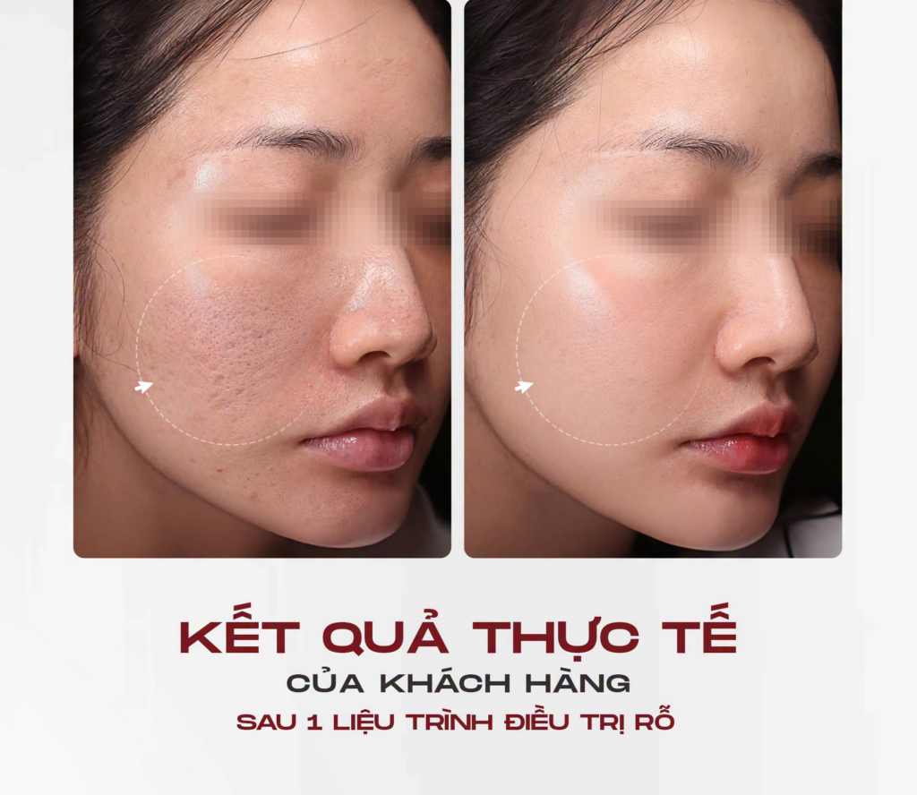 Kết quả trước và sau Meso Scar Therapy tại Shynh Medical Clinic
