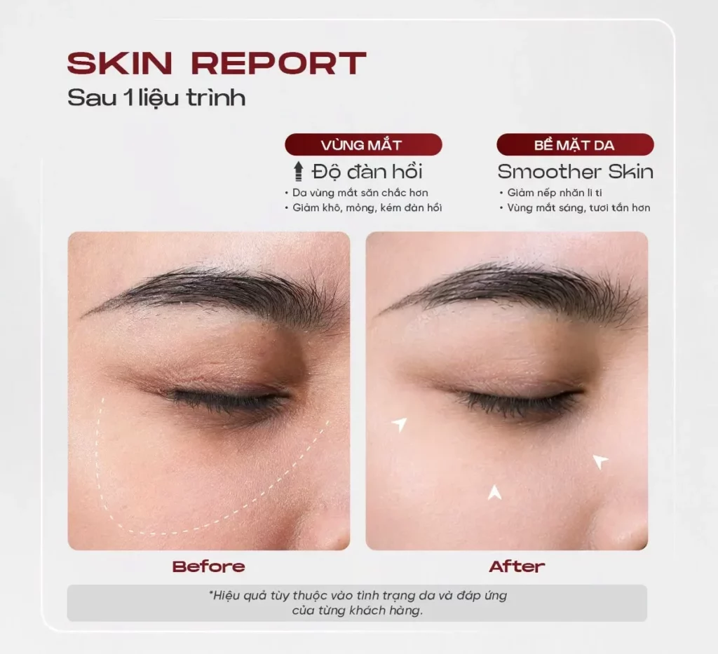 Hình ảnh trước và sau khi thực hiện Shynh Rejuran Pro