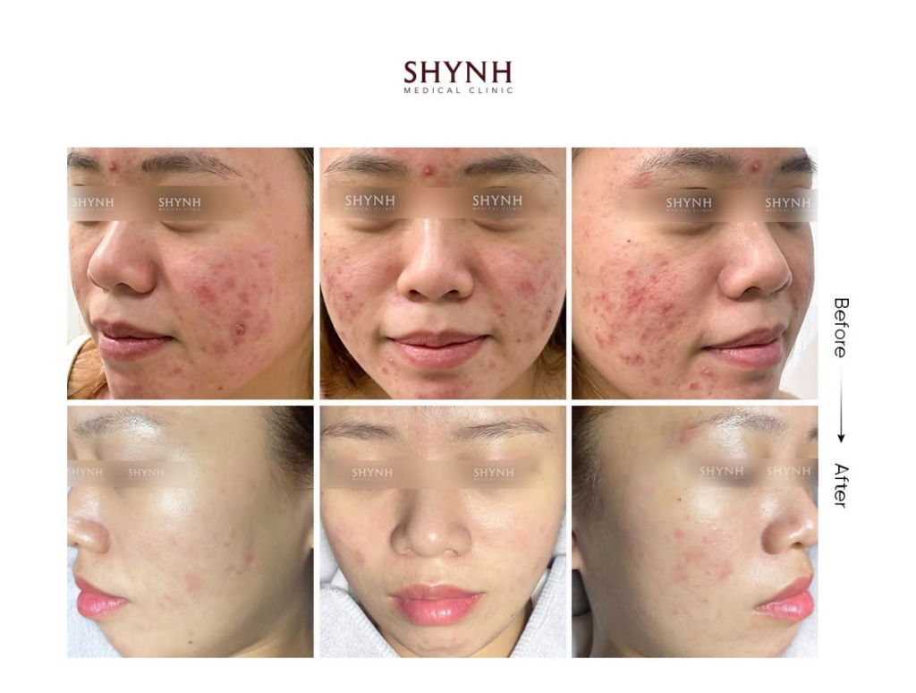 Kết quả trước và sau Meso Scar Therapy tại Shynh Medical Clinic