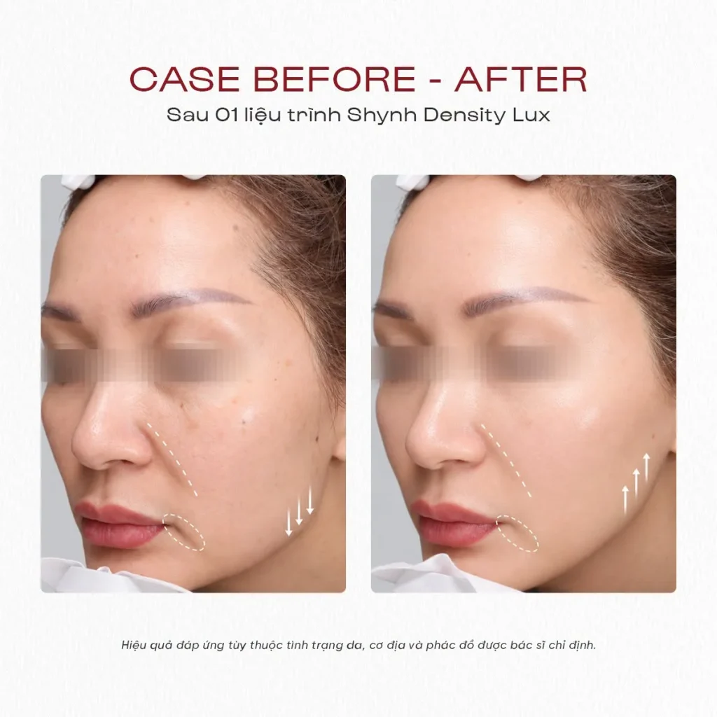 Shynh Density Lux chăm sóc đường nét và độ nâng đỡ gương mặt