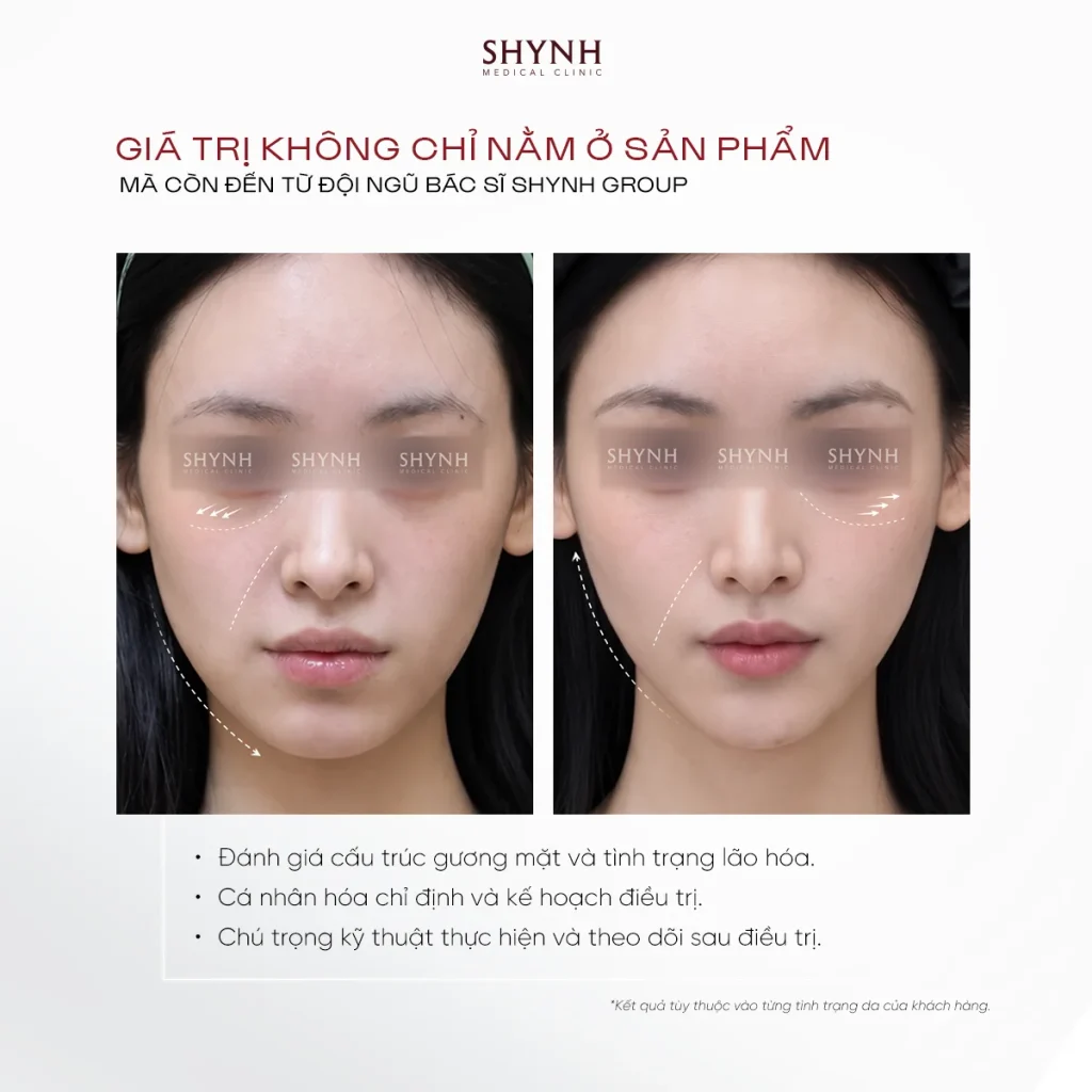 Hình ảnh trước và sau liệu trình Sculptra cải thiện độ đầy đặn gương mặt
