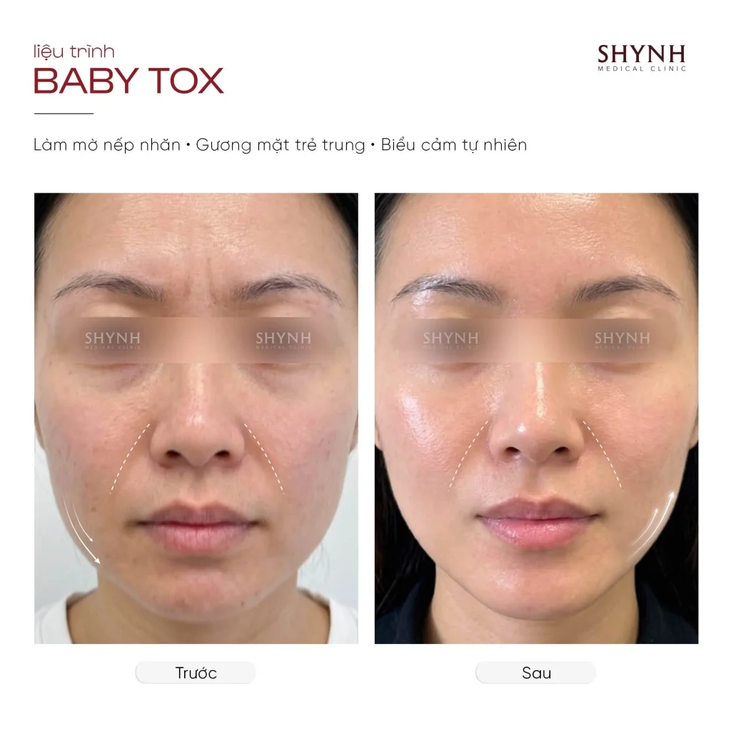 Đánh giá nếp nhăn biểu cảm trước khi thực hiện Baby Tox.