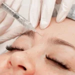 Các vùng gương mặt có thể được chỉ định tiêm Filler như môi má và cằm