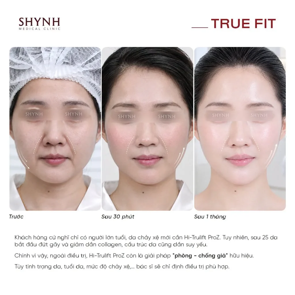 Bác sĩ đánh giá tình trạng da và cơ mặt trước khi tư vấn Hi-Trulift Pro kết hợp Botox