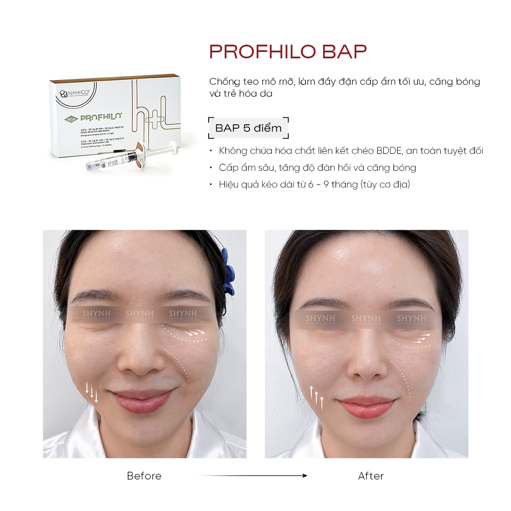 Profhilo hỗ trợ cải thiện độ ẩm và độ đàn hồi của da