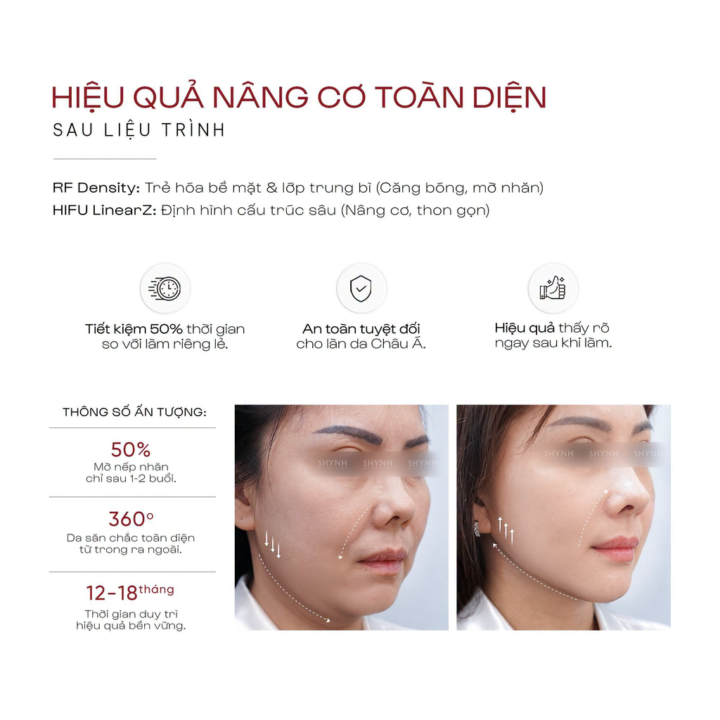 Công nghệ nâng cơ và trẻ hóa da HIFU LinearZ và RF Density