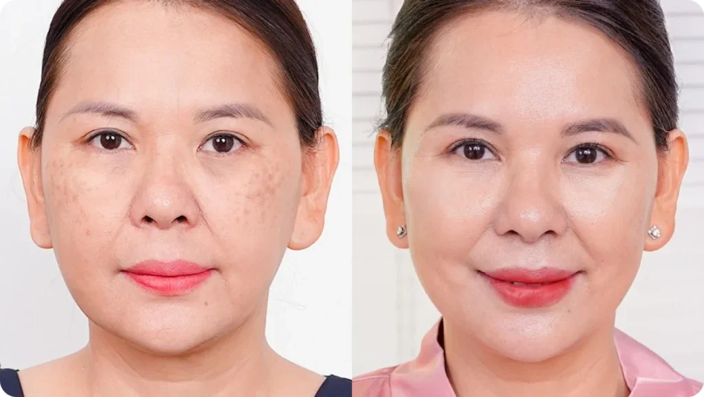 Hình ảnh làn da sau quá trình chăm sóc và cải thiện sắc tố